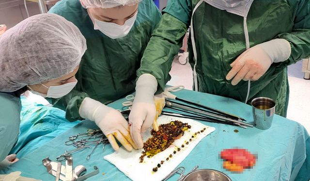 Karın ağrısıyla gitti, safrasından binlerce taş çıktı