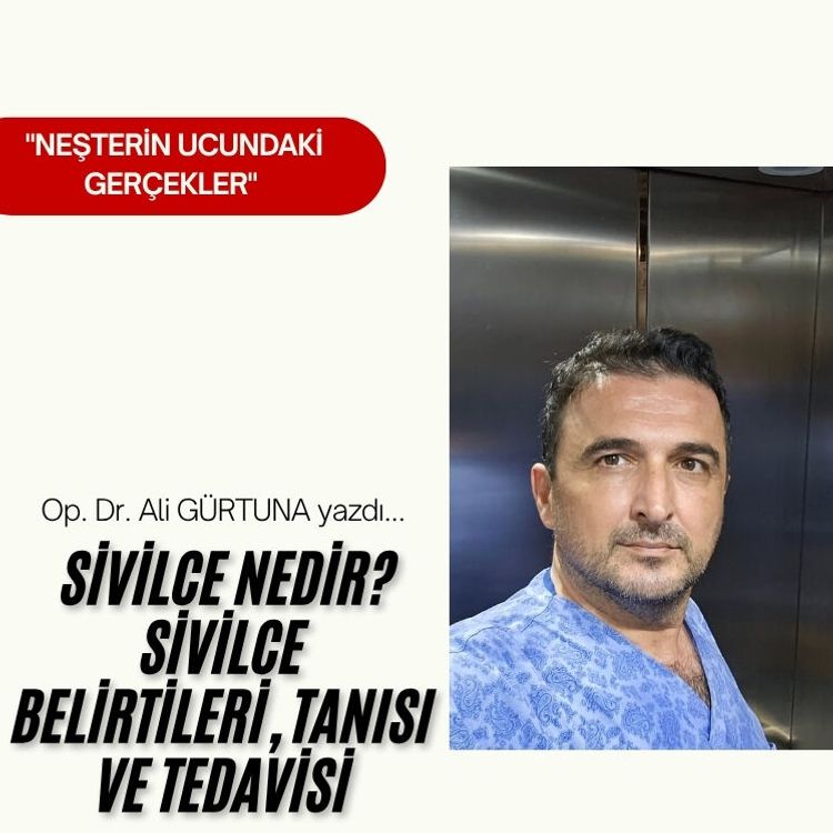 Sivilce Nedir? Sivilce Belirtileri, Tanısı ve Tedavisi