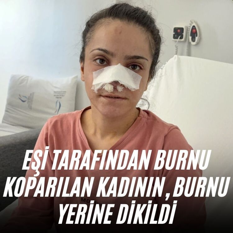 Eşi tarafından burnu koparılan kadının, burnu yerine dikildi